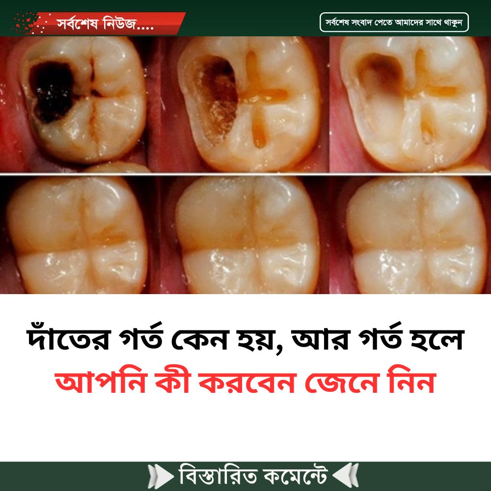 দাঁ’তের গ’র্ত কেন হয়, আর গ’র্ত হলে আপনি কী করবেন জেনে নিন