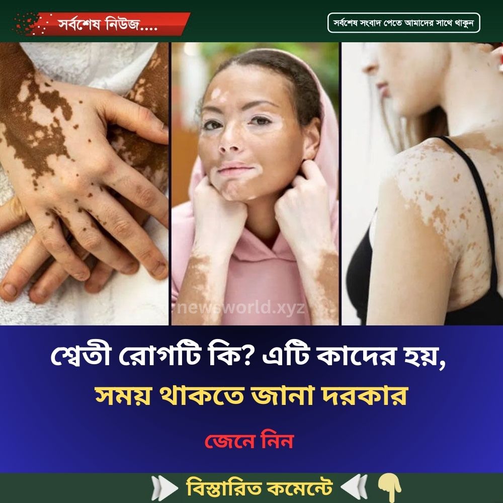 শ্বেতী রোগটি কি? এটি কাদের হয়, সময় থাকতে জানা দরকার