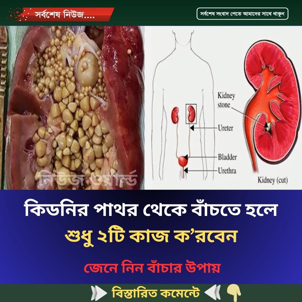 কি’ডনি’র পাথর থেকে বাঁ’চতে হলে শুধু ২টি কাজ ক’রবেন