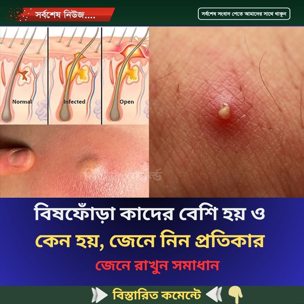 বিষফোঁড়া কাদের বেশি হয় ও কেন হয়, জেনে নিন প্রতিকার