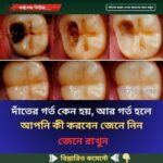 দাঁ’তের গ’র্ত কেন হয়, আর গ’র্ত হলে আপনি কী করবেন জেনে নিন