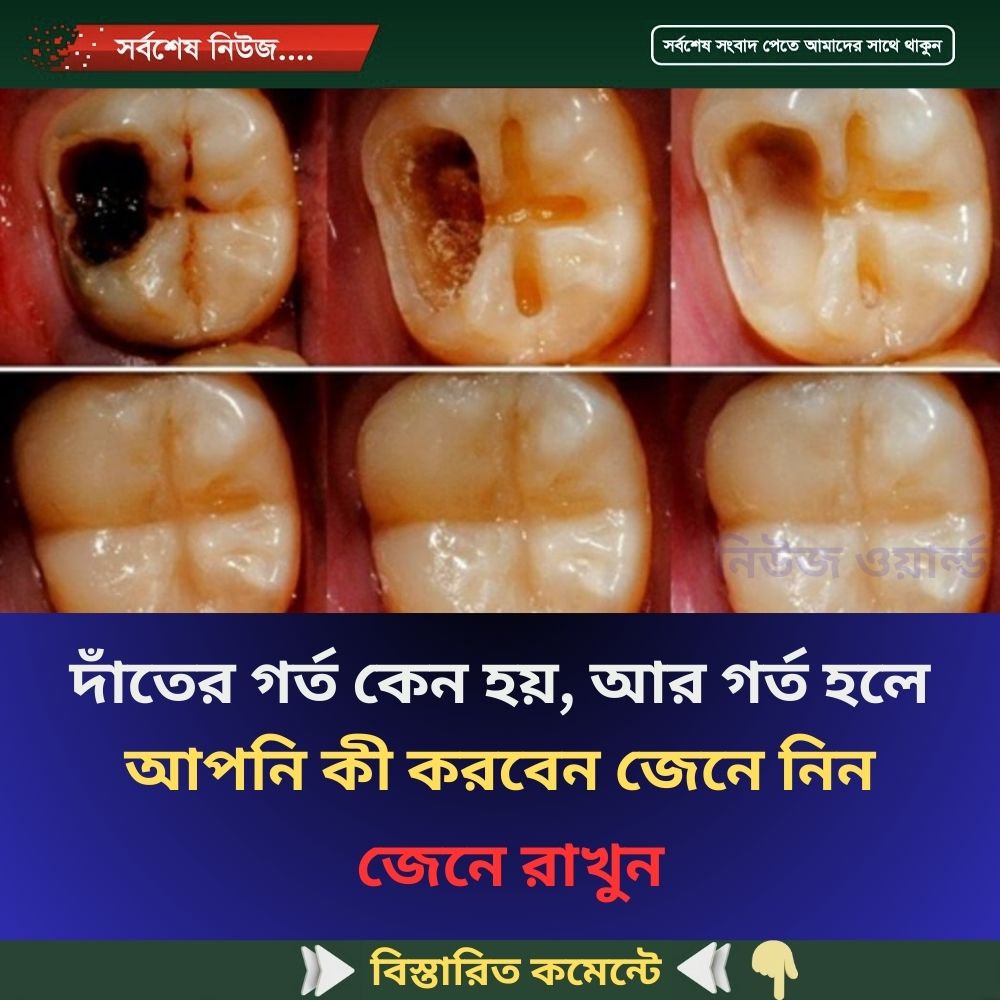 দাঁ’তের গ’র্ত কেন হয়, আর গ’র্ত হলে আপনি কী করবেন জেনে নিন