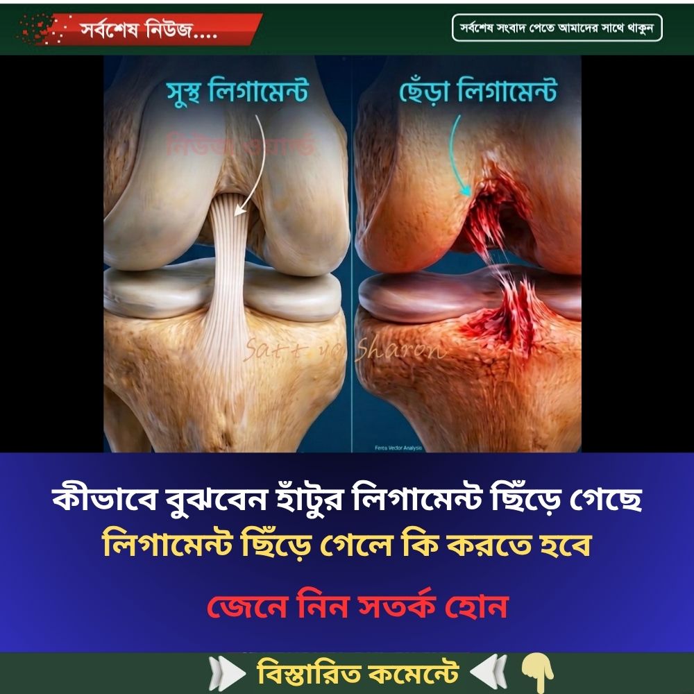 কীভাবে বুঝবেন হাঁটুর লিগামেন্ট ছিঁড়ে গেছে লিগামেন্ট ছিঁড়ে গেলে কি করতে হবে