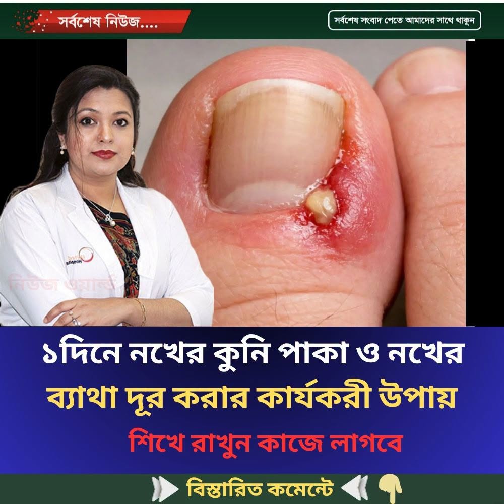 ১দিনে নখের কুনি পাকা ও নখের ব্যাথা দূর করার কার্যকরী উপায়…see more